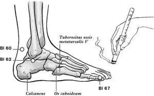 breech acupuncture and moxibustion